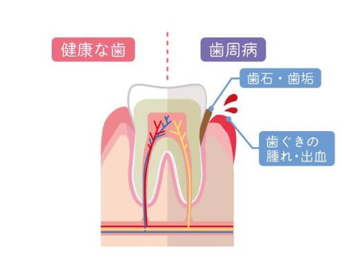 歯周病イメージ