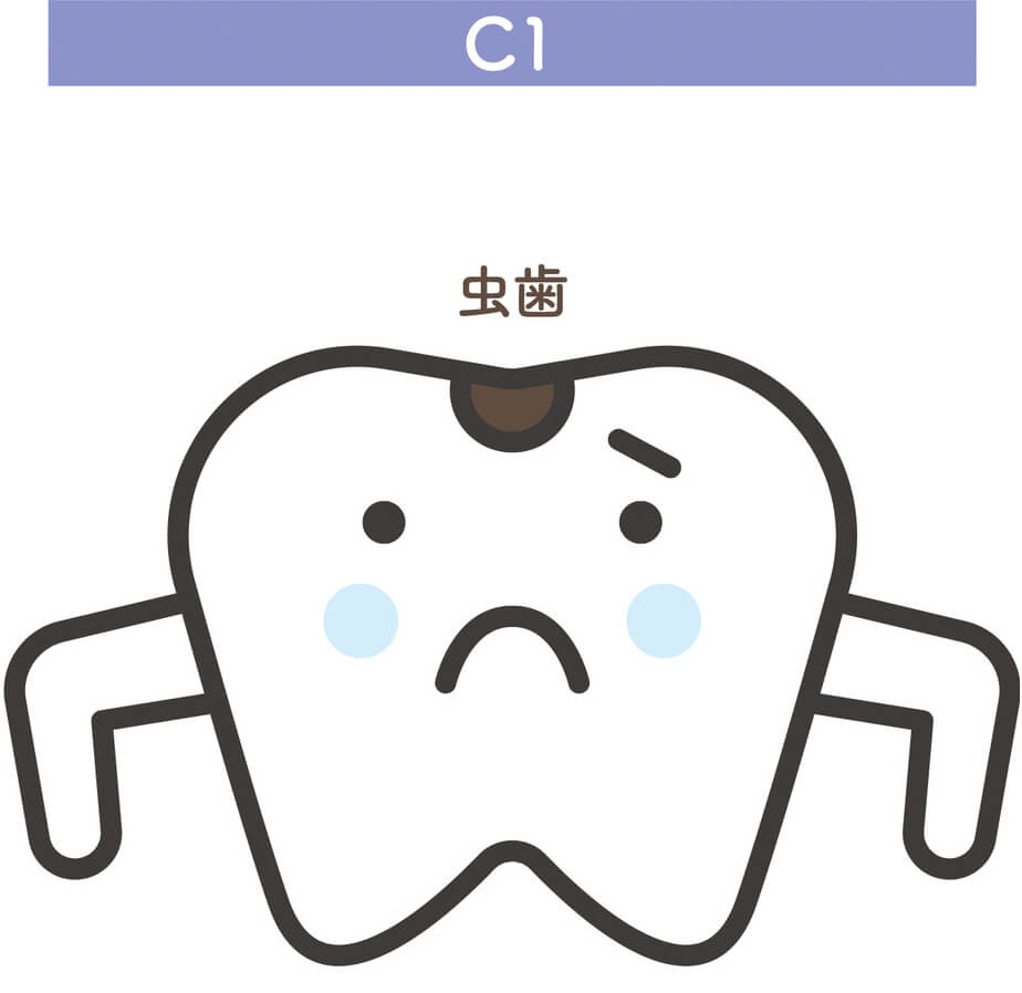 C1（軽度のむし歯）