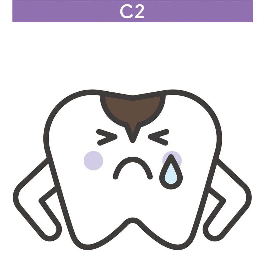 C2（中度のむし歯）