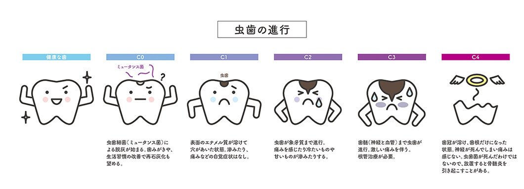 虫歯の進行段階