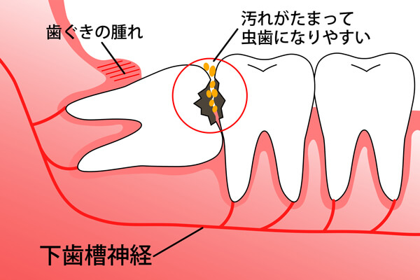 抜いたほうがいい親知らず　イメージ画像